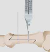 Scarf Osteotomy 1-1 Place a bone clamp to create the necessary compression across the osteotomy or fusion site (when applicable).