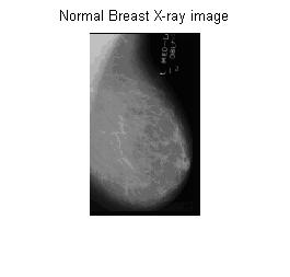 Table 1: Image fusion using Pixellevel averaging method, parameter analysis S.No. Parameter Normal X-ray X-ray Mammogram with Microcalcification 1 RMSE 55.93 44.6618 6.8591 PSNR 13.1791 15.130 19.
