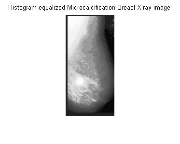 Histogram of Microcalcification Breast Figure 4: Image fusion using Simple Weighted Averagemethod for Normal Breast Mammogram (e) Fused image of