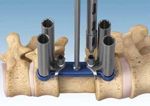 Step 10 Bone Screw Insertion Follow steps 6-8 for screw placement in the remaining holes.