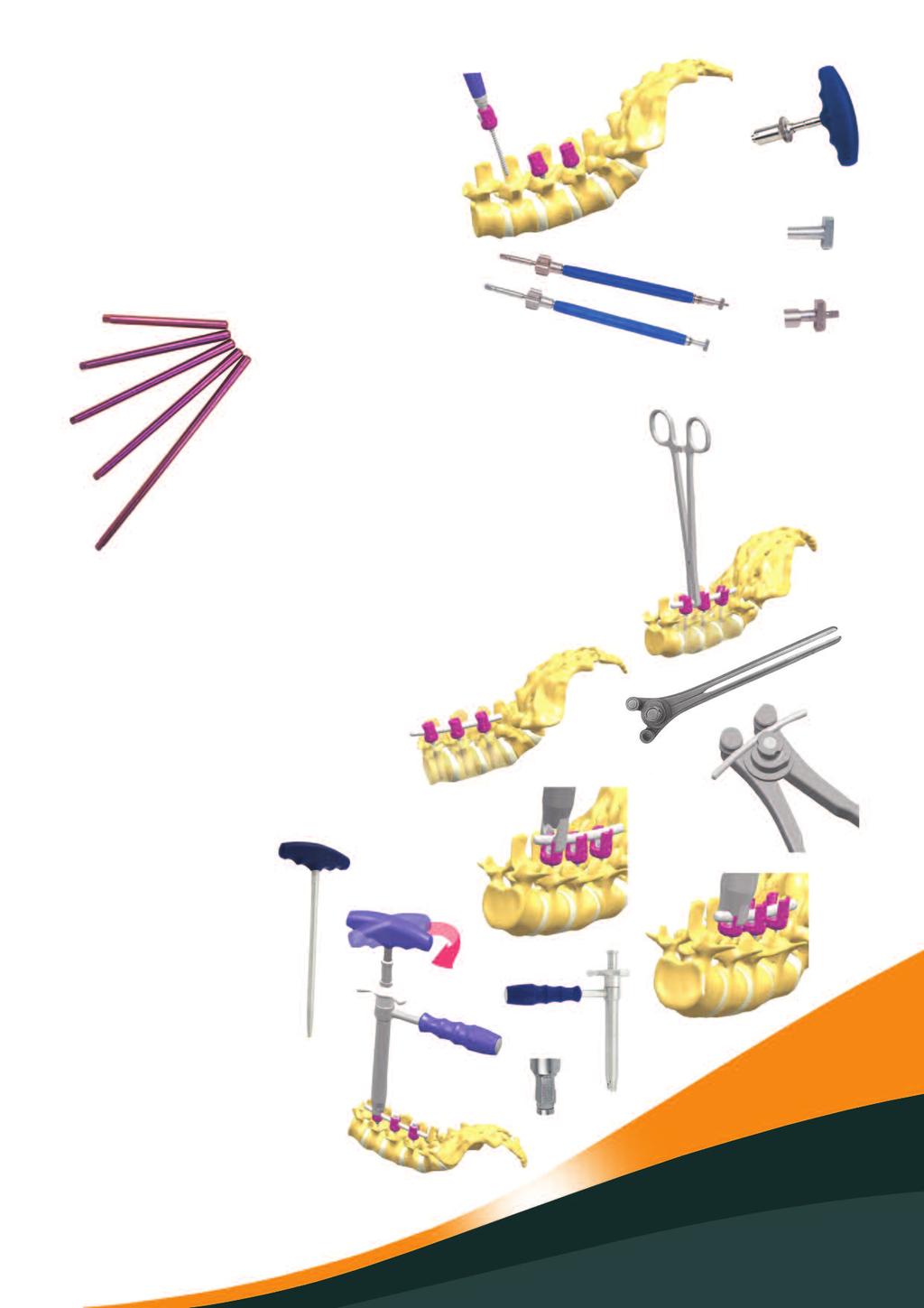 Screw Selection and Insertion The pedicle screws are available in several diameters and lengths.