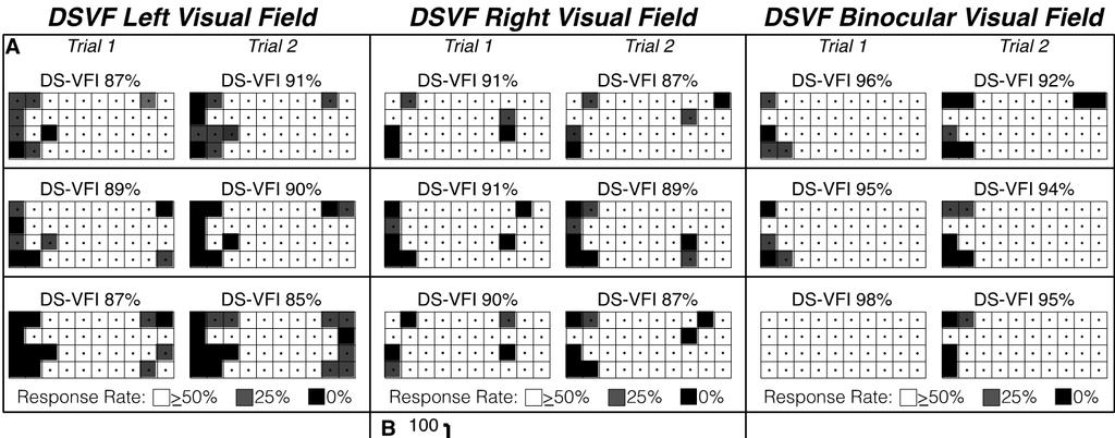 A DSVF Left Visual Field DSVF
