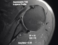 Comparison of low-high profile order and asymmetric TSE in the shoulder demonstrates that a-tse reduces blurring and acquisition time.