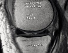 an ES of between 8 and 12 ms, and a shot length of 120 ms. Asymmetric TSE allows independent selection of TE, TF and ES, continues Dr. Feller, who has used a-tse since October 2006.