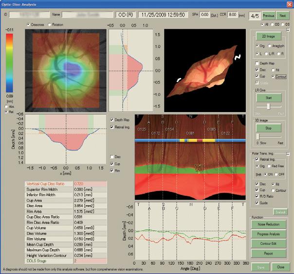 6 Confidently diagnose your glaucoma patients with Kowa s VK-2 WX analysis software 1 2 4 1 2 4 Depth Distribution Colour-coded display of the depth distribution, with the ability to display
