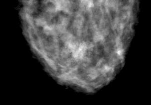 tomosynthesis and mammography we generated an anthropomorphic 3D model of the breast by using the dedicated BreastSimulator software [6].