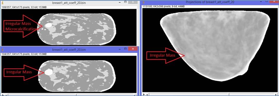 Twenty six projection images in a tomosynthesis mode are simulated by using [6]. The incident beam energy was 20keV and the beam was monochromatic. Scatter and detector responses were not simulated.