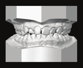 Digital analytics tools include: teeth width, space, T-J Moyers, Bolton, arch width, canine distance, and overbite/overjet measurements,