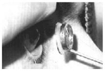 Electro-OculoGraphy