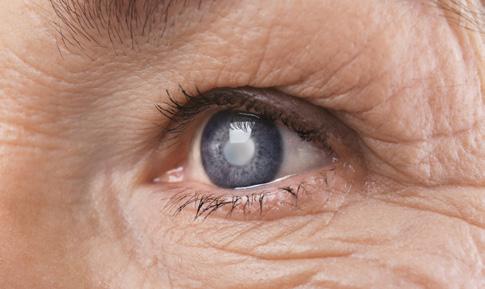 Iris: Melanoma tumors are the most common cancer of the eye, and evidence suggests that UVR is one of its leading causes. When Figure 7.