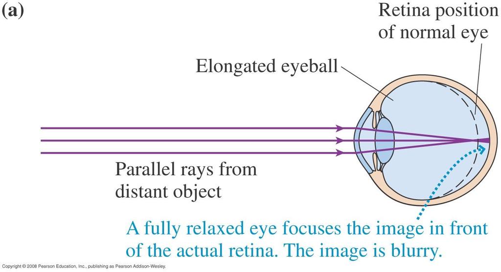 Myopia (near-sightedness) To focus an image of the object which is at