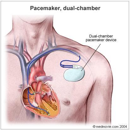 HEART PACEMAKER AND