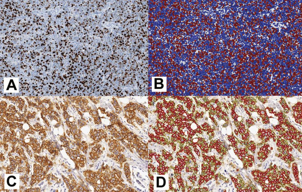 Figure 3. Example of image analysis results. A, A section of a mantle cell lymphoma was stained for Ki-67.