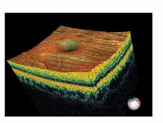 Retina Mapping 3D Macula Retinal mapping and analysis Retina mapping with normative comparison,