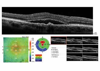 Pachymetry and Epithelial Thickness Mapping Anterior Segment Angle with Measurement