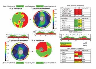 reports for pachymetry and epithelial thickness mapping, anterior segment angle measurement and