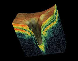 GCC thickness mapping improves clarity in structural change identification.