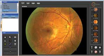 With ifusion, you can quickly overlay ivue OCT images onto the fundus photos.