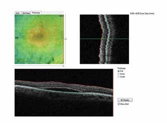 Retina Mapping 3D Retina High-density 3D retinal imaging Retinal imaging capabilities include HD crossline scanning and 3D