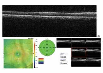 Pachymetry and Epithelial Thickness Mapping * Anterior Segment Angle with Measurement Anterior segment imaging and measurement