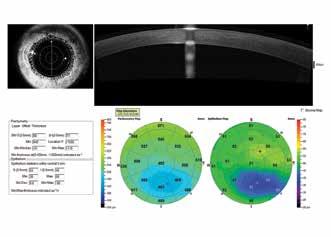 mapping, a variety of corneal and angle measurement tools and exclusive Vault Mapping.