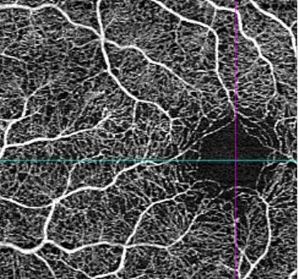 Supplement 197 Ophthalmic Optical Coherence Tomography for Angiographic Imaging StorageSOP Classes Page 20 215 Figure C.8.17.5-1: En face Image Ophthalmic Anatomic Reference Point Location Example C.