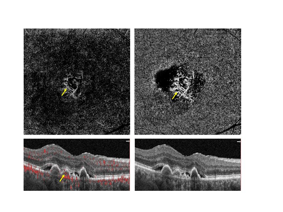 Supplement 197: Ophthalmic Optical Coherence Tomography for Angiographic Imaging StorageSOP Classes Page 53 the PED and incremental regression of the subretinal neovascular membrane by point to point