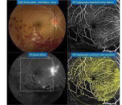 Supplement 197 Ophthalmic Optical Coherence Tomography for Angiographic Imaging StorageSOP Classes Page 54 575 580 UUU.1.2 Research Examples UUU.