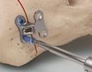 7 8 Remove one K-Wire and drill the hole for the first locking screw using the