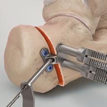 The S-shaped retractor can be used to facilitate further displacement.