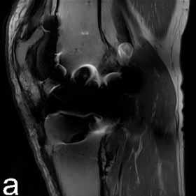 MRI with knee prosthesis at 3T Standard sequence