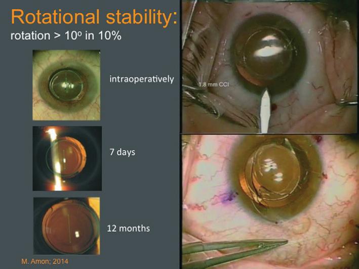 surface is concave so as to prevent contact with the primary IOL in the capsular bag.