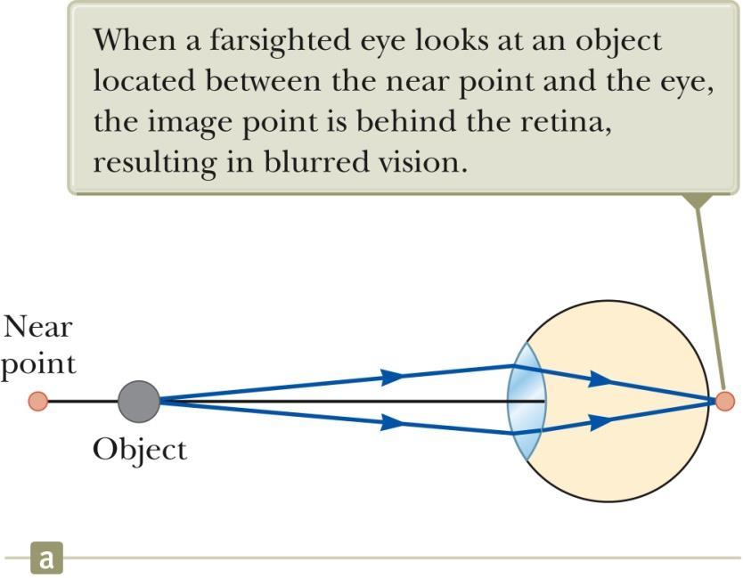 Farsightedness Also called hyperopia The near point of the farsighted person is much farther away than that of the normal