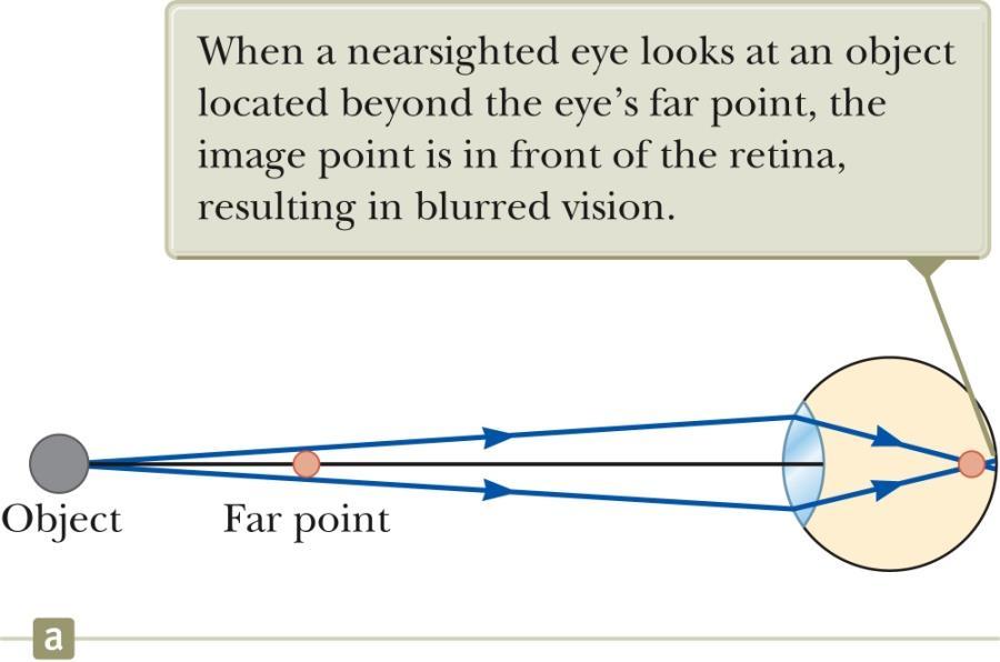 Nearsightedness Also called myopia The far point of the nearsighted person is not infinity and may be less