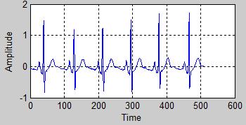 Thus we have tried to reduce the mean square error e[n] by using LMS algorithm. The error signal e[n] contains not only the error due to parameter misadjustment, but also the ECG signal g[n].