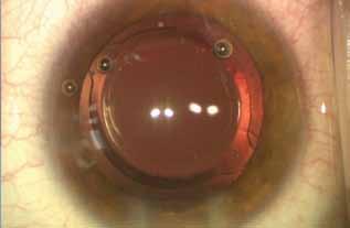 toric iols: myth versus reality Debunking some of the conventional wisdom about the implantation of these lenses. By Ike k.