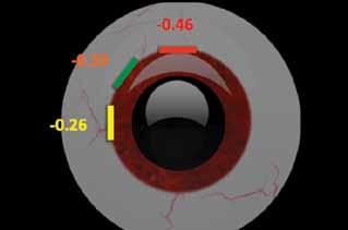 8 When implanting a toric IOL, we should be aiming for as precise an alignment of the axis as possible, ideally within 5º of the intended axis.
