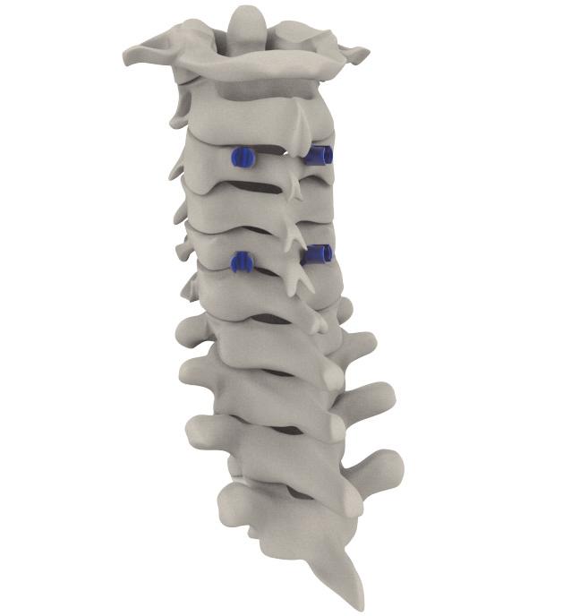 Step 1 Positioning and Exposure The patient should be positioned as appropriate for a posterior approach, taking care to preserve or improve sagittal alignment of the spine.