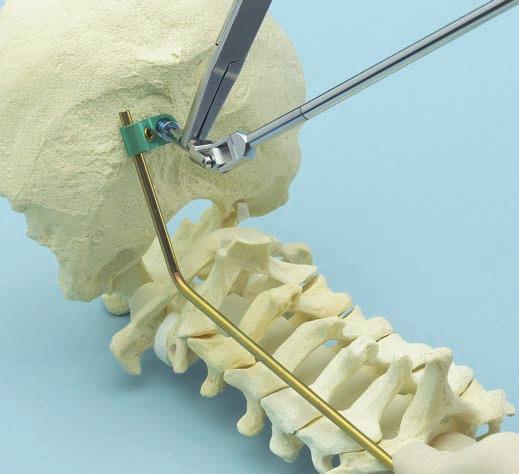 0 mm occipital screw may be used if the primary screw has less than optimal fixation. Optional instruments 03.161.