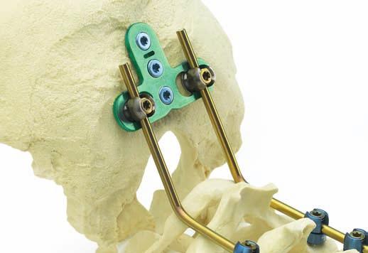 Overview The Synthes Occipito-Cervical Fusion System is intended to provide stabilization and promote fusion of the occipito-cervical junction.