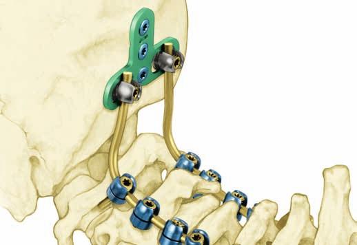 posterior cervical and thoracic rod-screw systems.