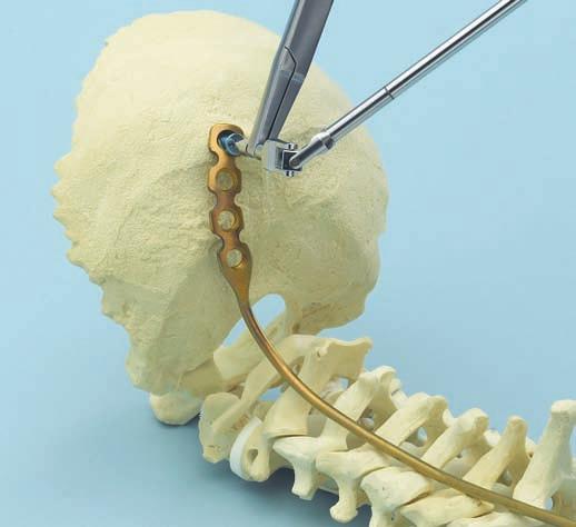 0 mm occipital screw may be used if the primary screw has less than optimal fixation. Optional instruments 03.161.