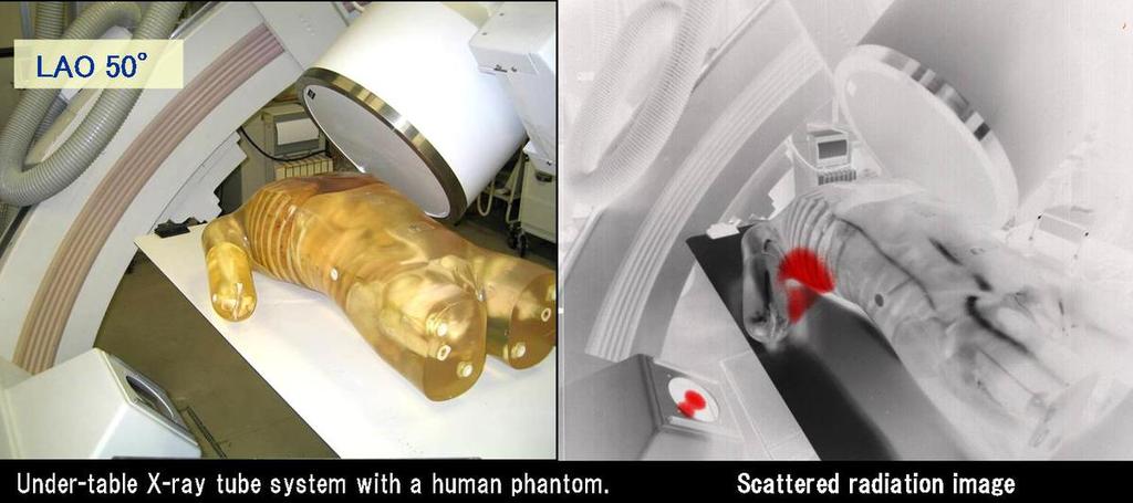 Fig. 6: Scattered radiation image for LAO 45 + Cranial 20. (The black in the radiographic image was changed to red, facilitating visualization.