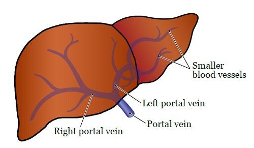 PATIENT & CAREGIVER EDUCATION About Your Portal Vein Embolization This information will help you g et ready for your portal vein embolization at Memorial Sloan Kettering (MSK).