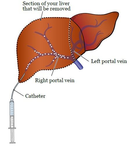 Fig ure 2. Portal vein emobolization in the rig ht portal vein When the blood flow is blocked, the sections of your liver with the tumor will get smaller.