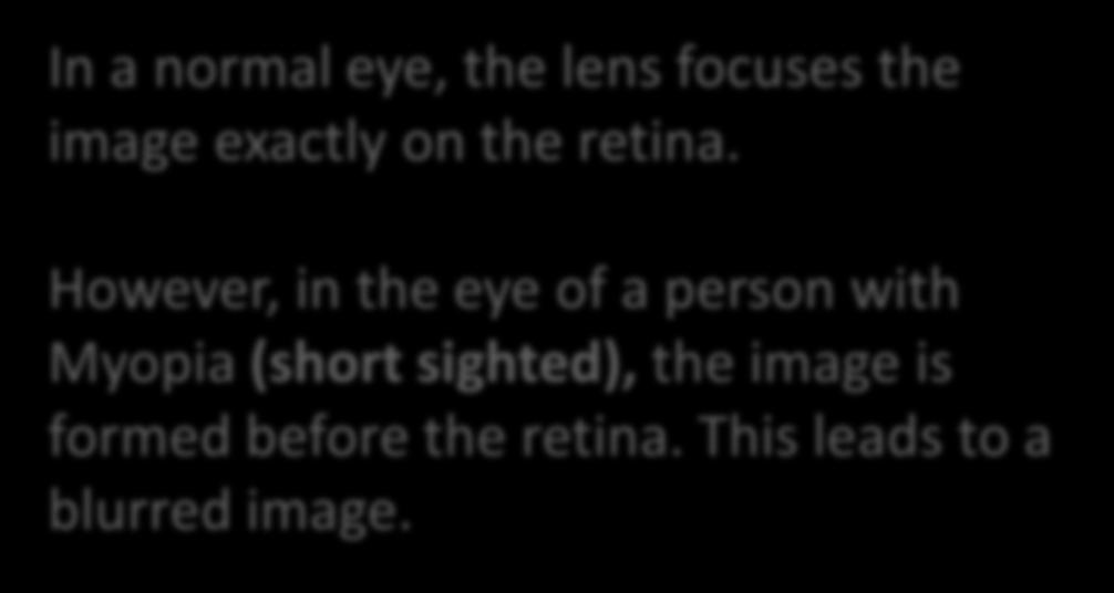 Short sighted In a normal eye, the lens focuses the image exactly on the retina. However, in the eye of a person with Myopia (short sighted), the image is formed before the retina.