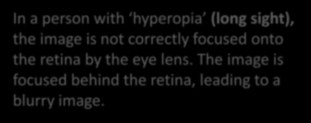 the lens so that they are refracted perfectly onto the retina.