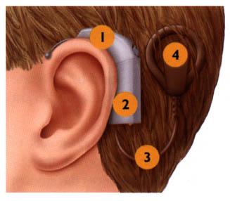 (b) Internal components are (5) receiver/stimulator, (6) electrode array, and (7) vestibulocochlear nerve.