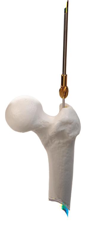 The C-arm should be used to visualize the depth of the reamer in the proximal femur.