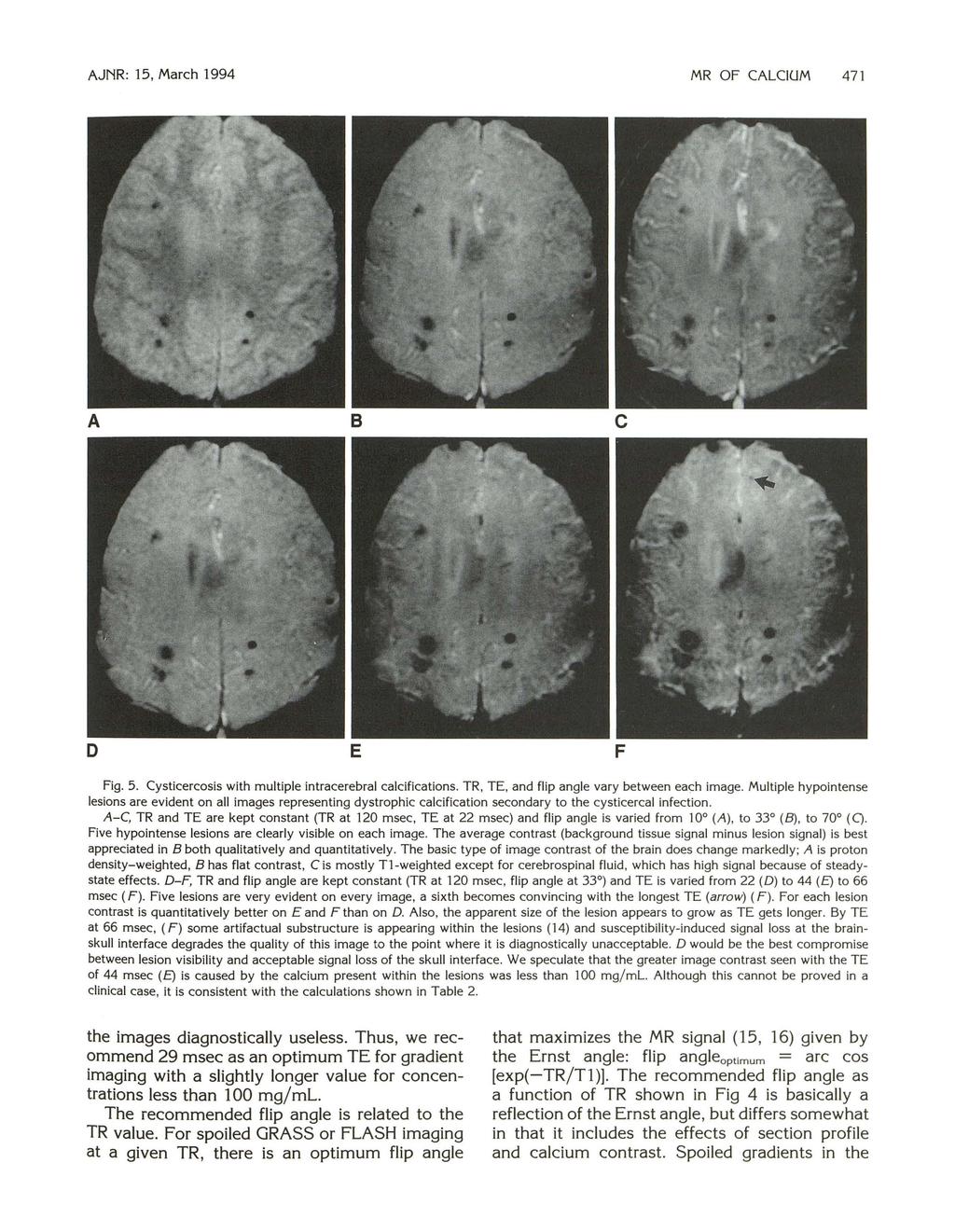 AJNR: 15, March 1994 MR OF CALCIUM 471 A B c D E F Fig. 5. Cysticercosis with multiple intracerebral calcifications. TR, TE, and flip angle vary between each image.
